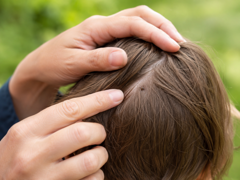 Zecke im Haar finden